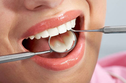 Tooth Colored Fillings in Tumwater, WA - Affordable Family Dental