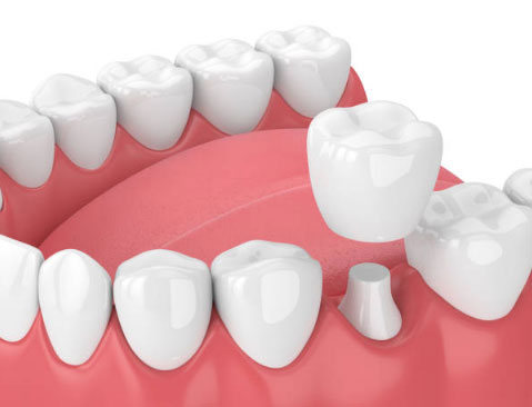 Dental Crowns in Tumwater, WA - Affordable Family Dental