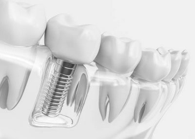 Dental Implants in Tumwater, WA - Affordable Family Dental