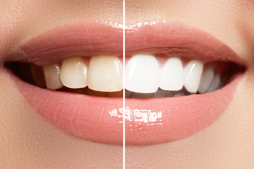 Teeth Whitening Affordable Family Dental dentist in Tumwater and Olympia, WA Dr. Ajaipal Dhanoa