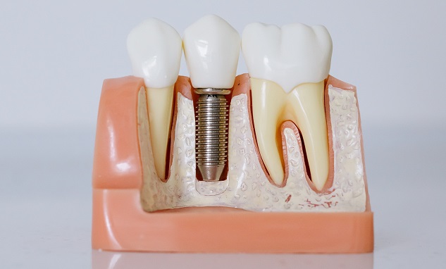 Dental Implants Are The Solution For Missing Teeth
