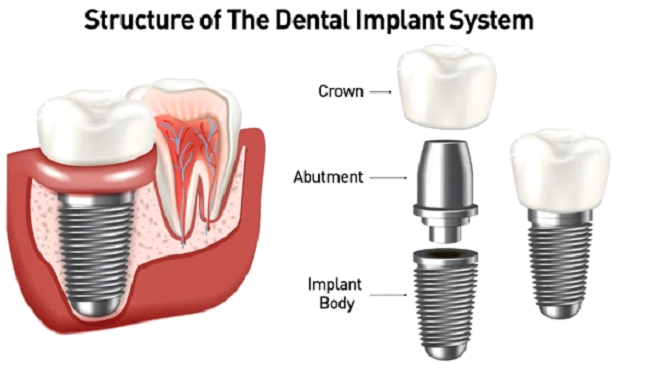 Types of Dental Implants