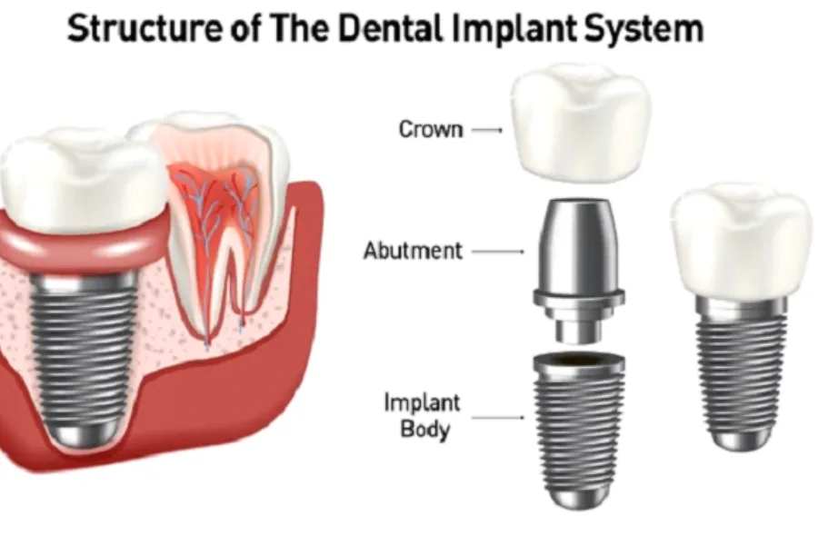 dental Implants