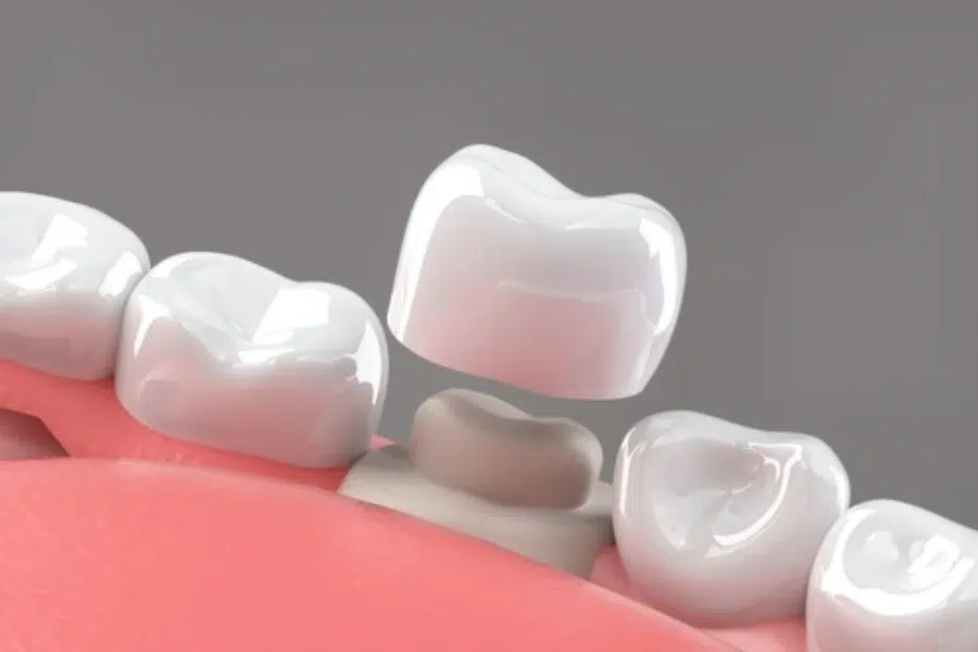 dental crowns
