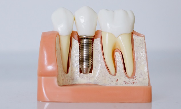 Dental-Implant-Photo-cropped