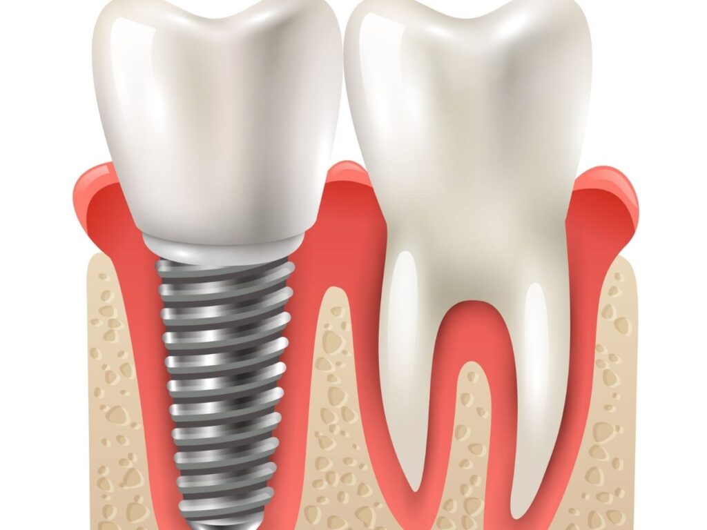 Dental Implants
