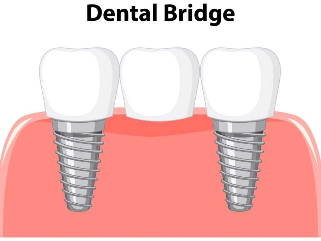 Dental bridge