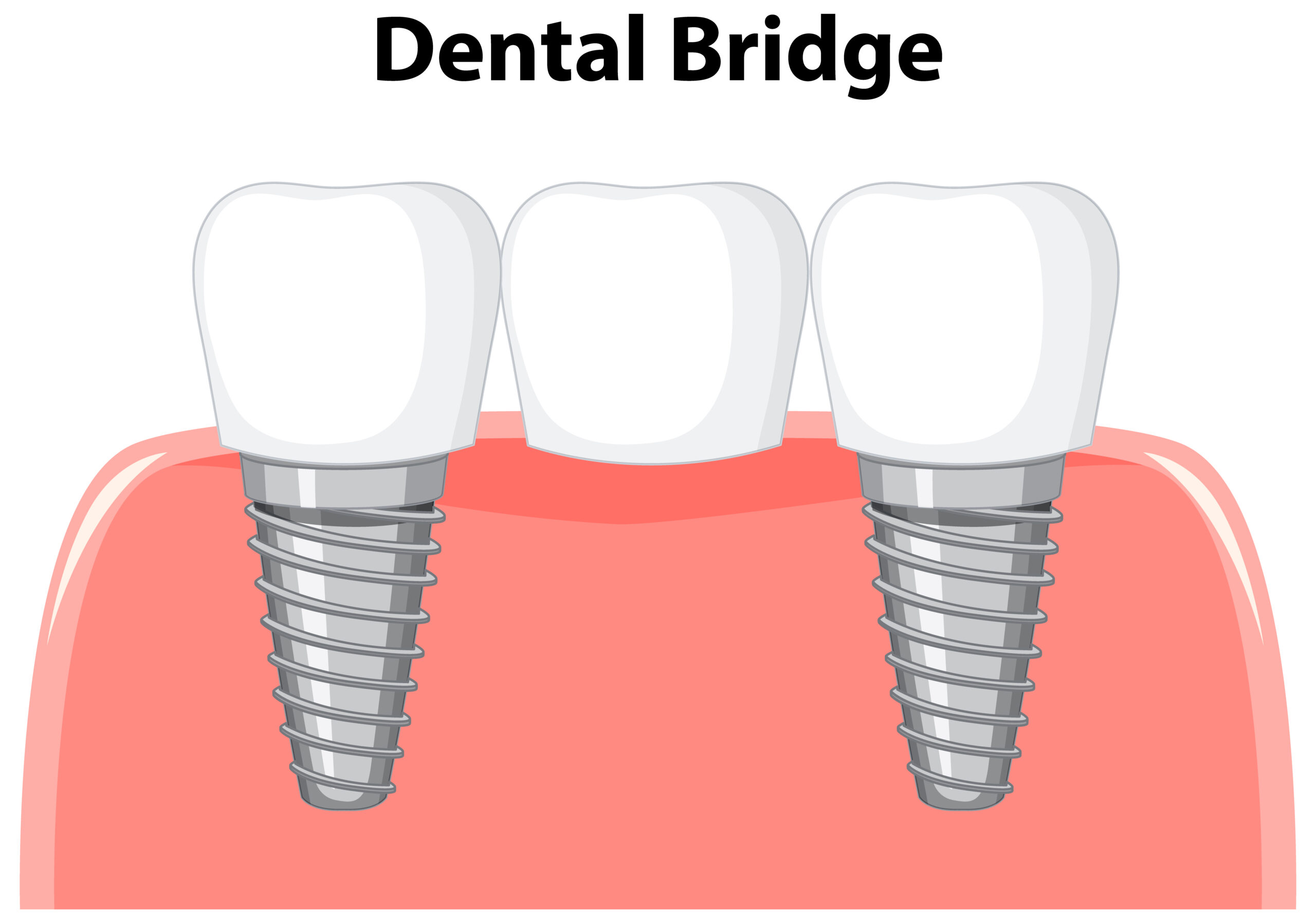Dental bridge