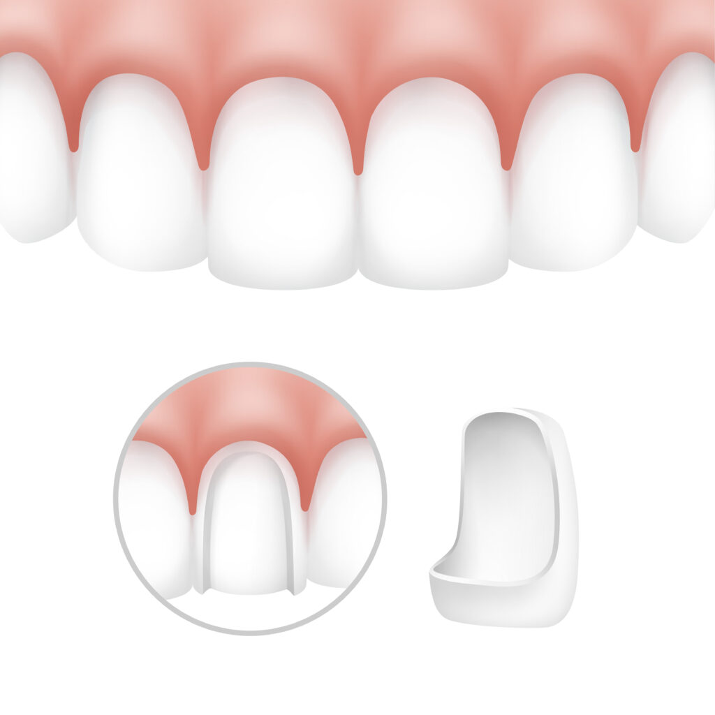 What are Veneers