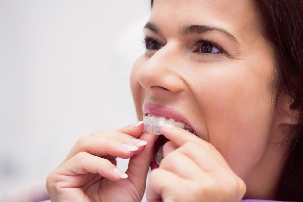 Clear aligners Tumwater