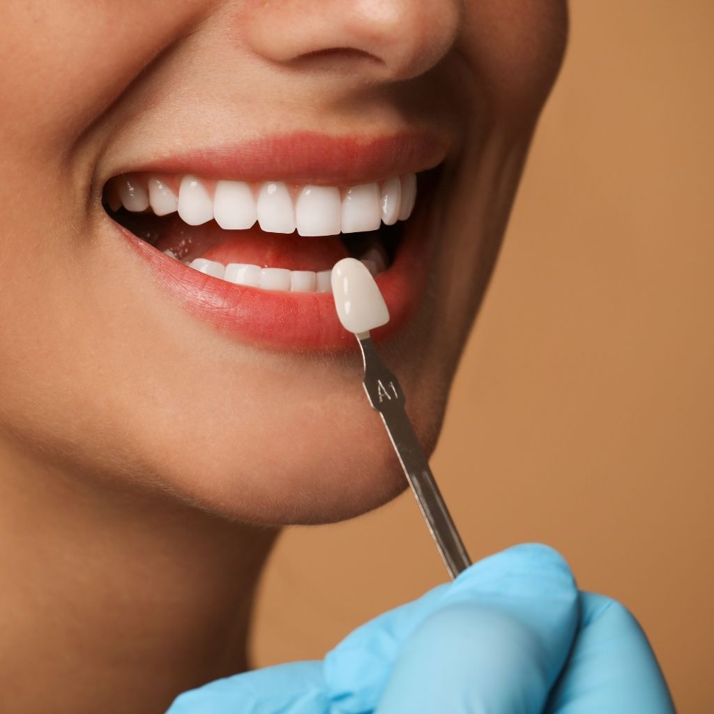 veneer bonding procedure