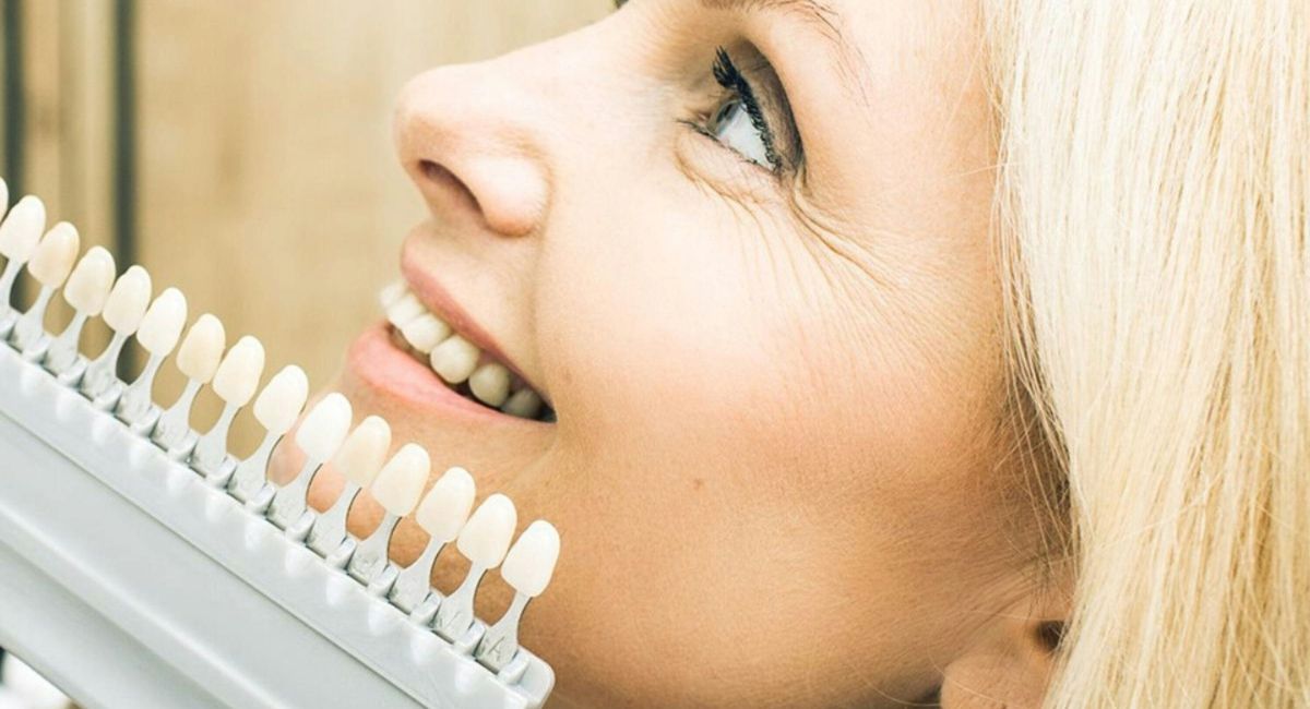 Dental Veneers