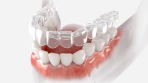 Clear Aligner