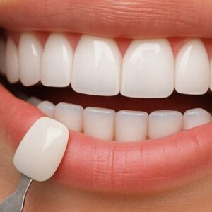 Dental Veneers