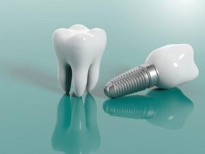 Dental Implants